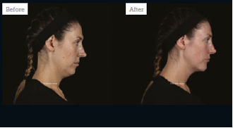 2021 – The AlumierMD Award for Best Non-Surgical Result